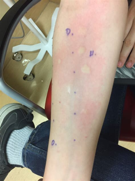 scratch test histamine|allergic reaction to histamine.